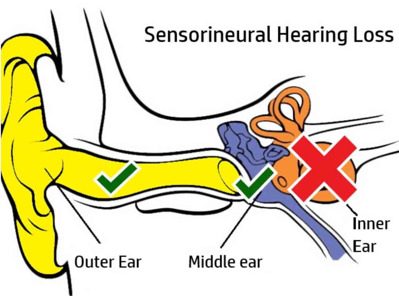 Sensorineural Hearing Loss