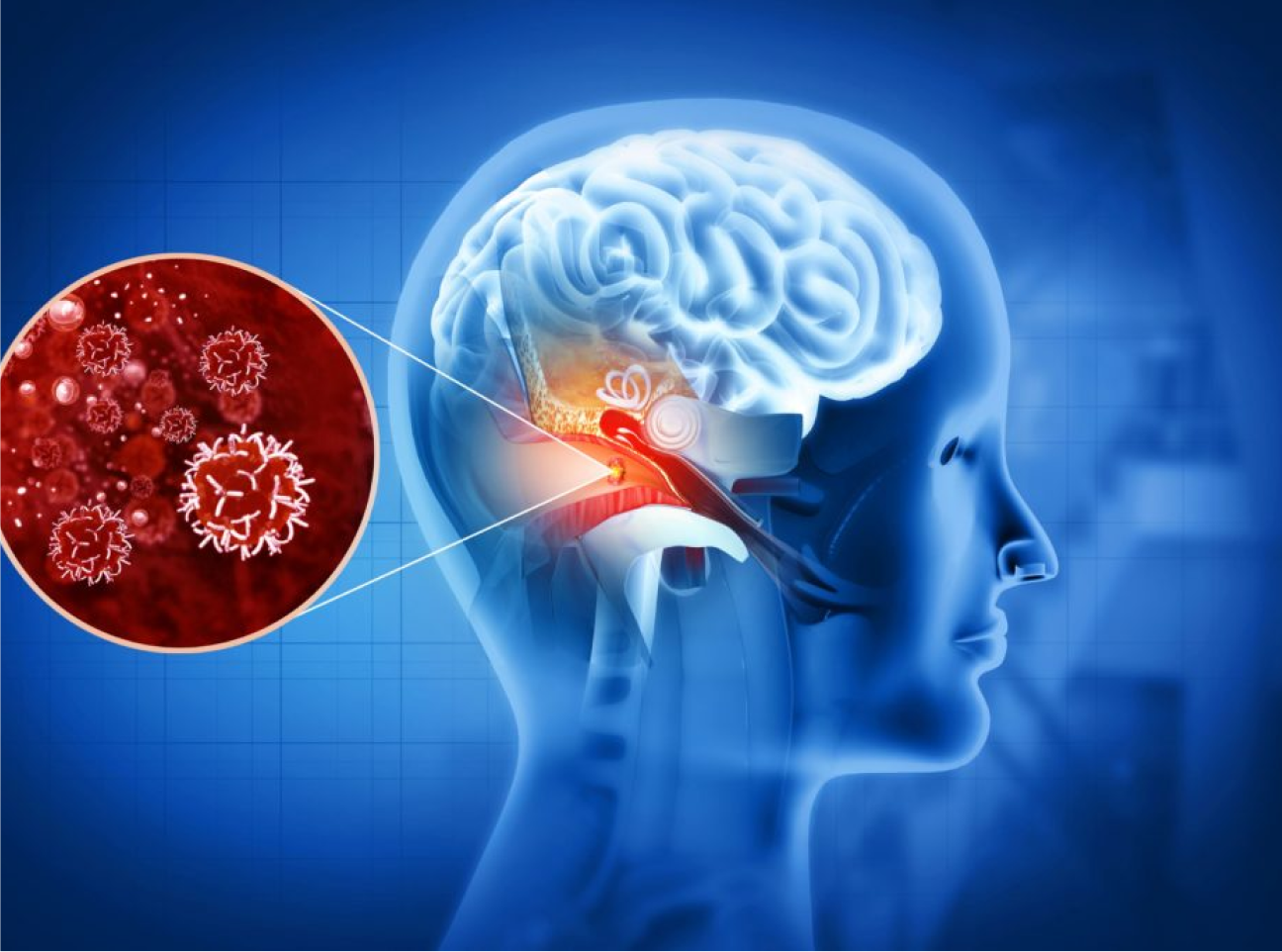 Infections