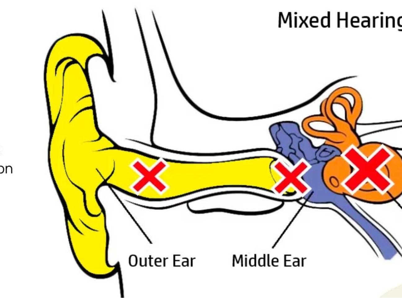 Mixed Hearing Loss