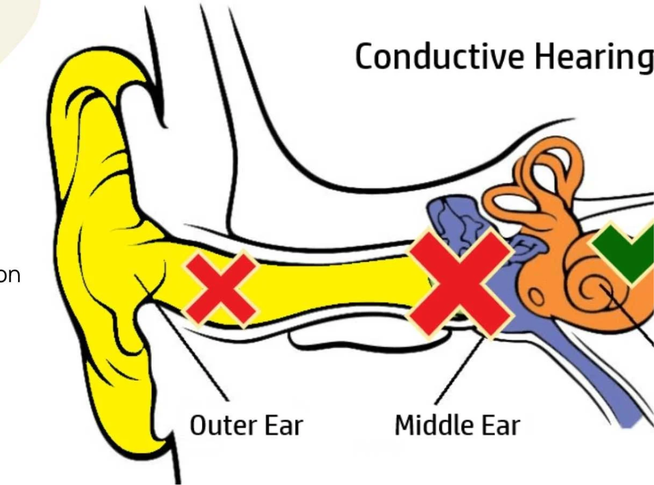 Conductive Hearing Loss