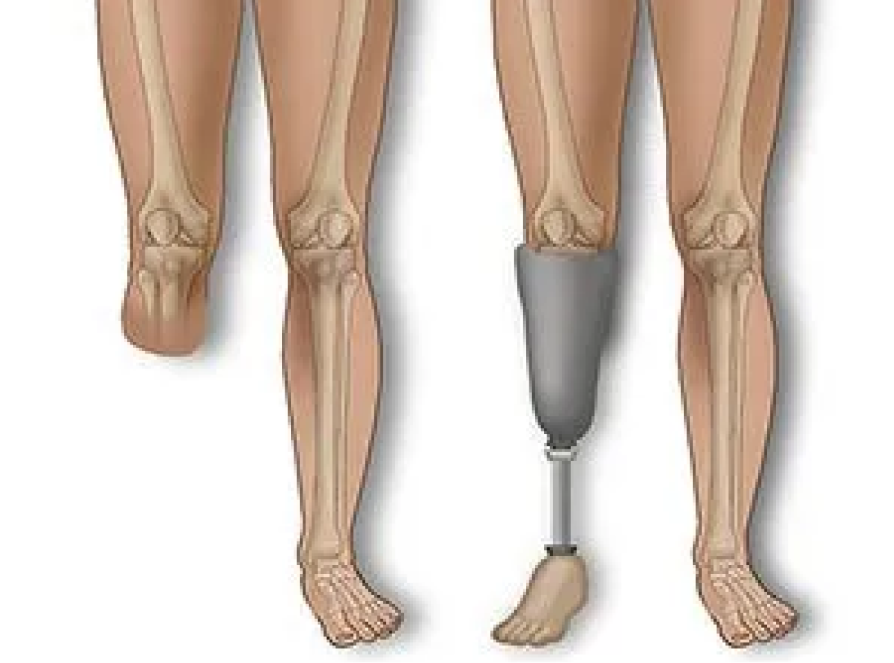 Amputation