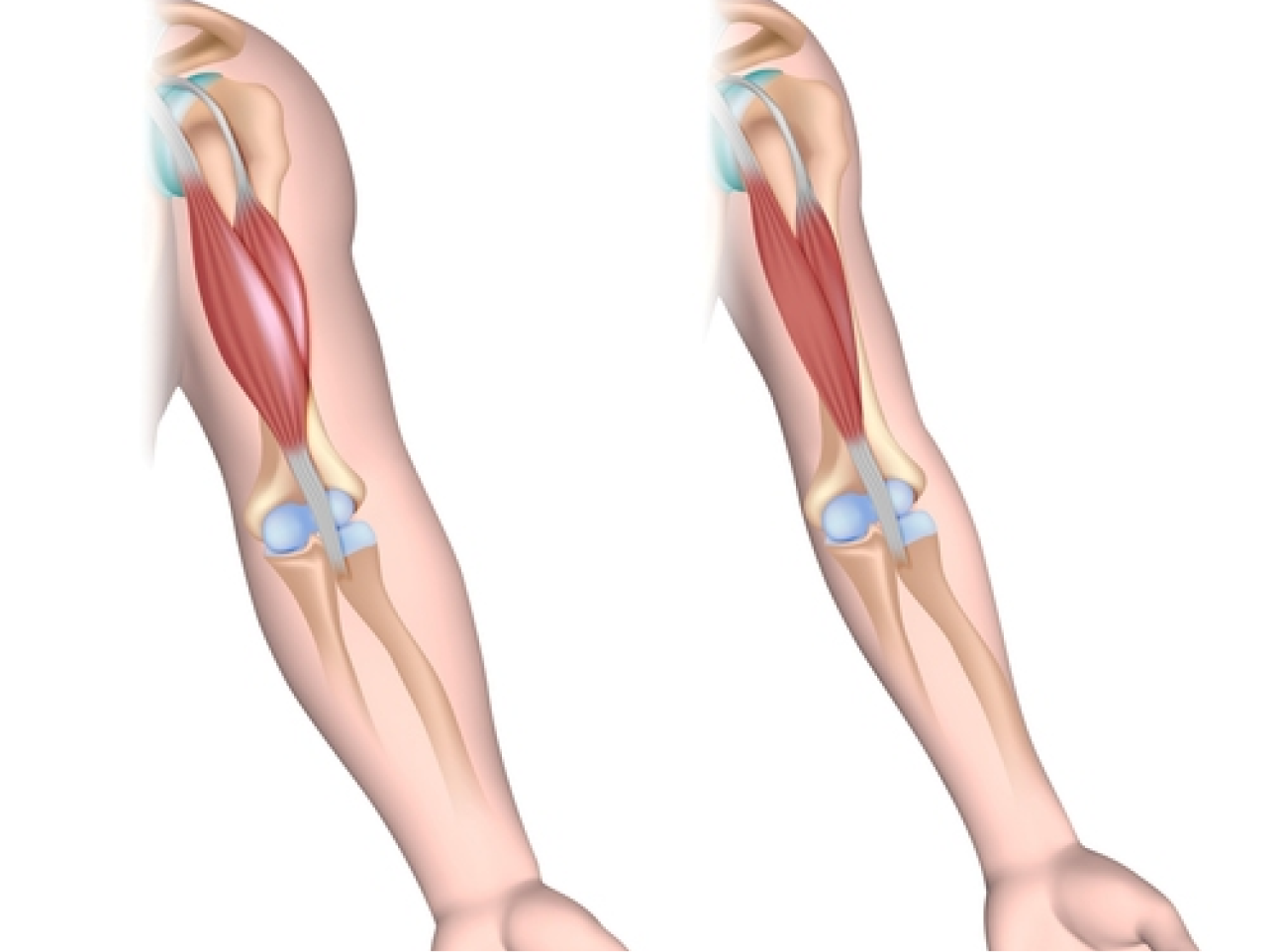Muscular Dystrophy