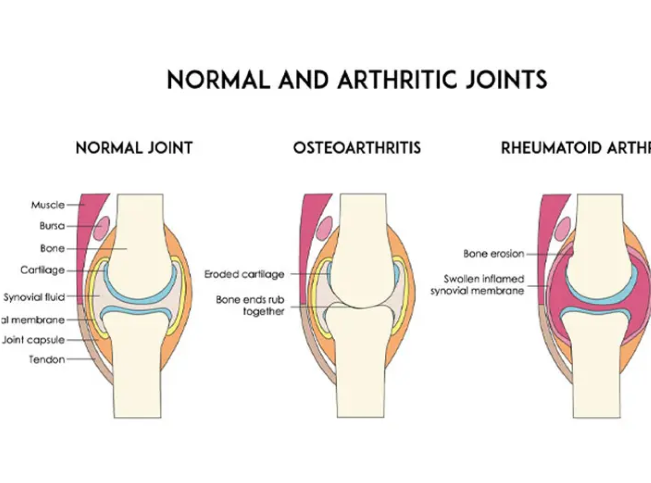 Arthritis