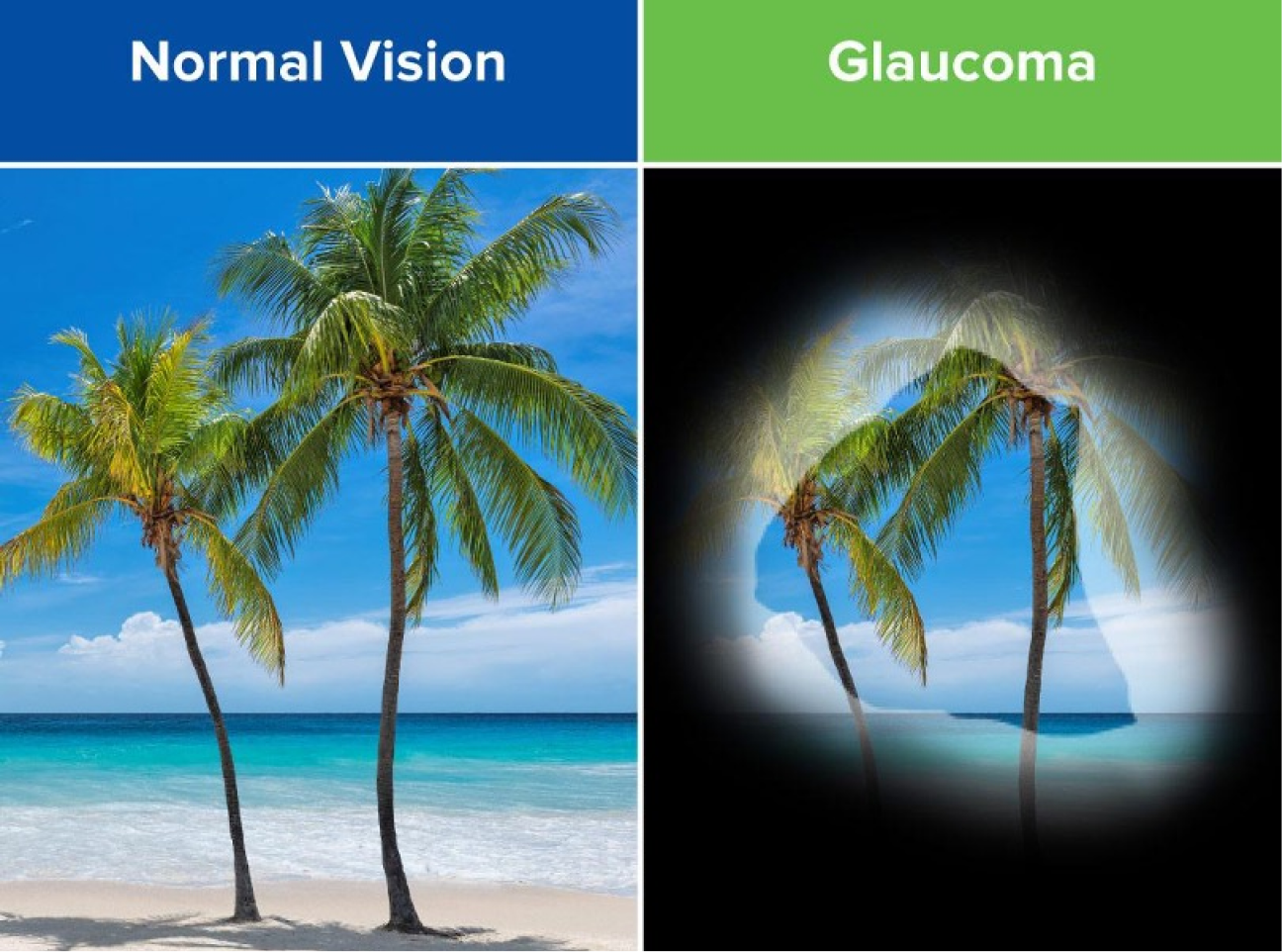Glaucoma